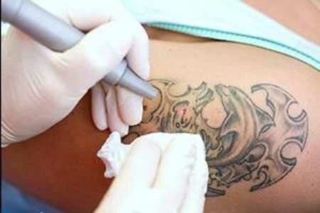 Видалення татуювання лазером